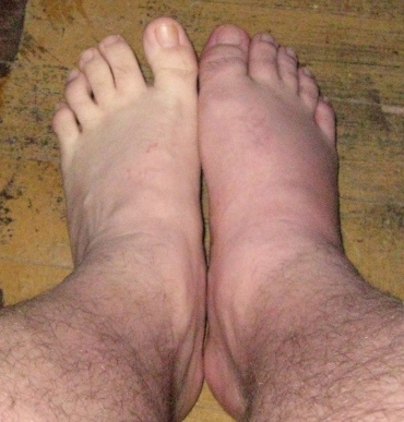 gout_feet2.jpg