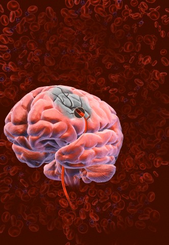 http://drtihanyi.hu/uploads/stroke2.jpg